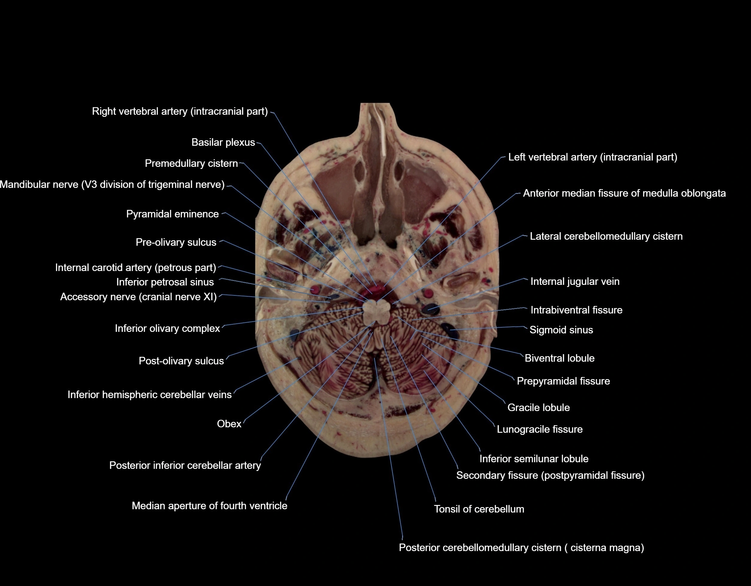MRI Brain axial cross sectional radiology anatomy 3T image  -img-000010.webp